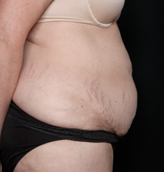 Tummy Tuck Before & After Patient #31118