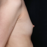 Breast Augmentation - Saline Implants Before & After Patient #31129