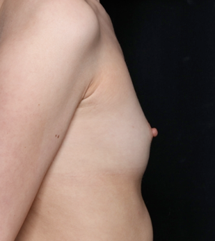 Breast Augmentation - Saline Implants Before & After Patient #31129