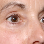 Blepharoplasty Before & After Patient #31075