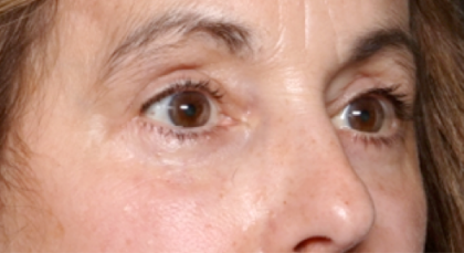 Blepharoplasty Before & After Patient #31075