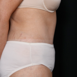 Tummy Tuck Before & After Patient #31118