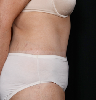 Tummy Tuck Before & After Patient #31118