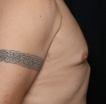 Gynecomastia Before & After Patient #31146