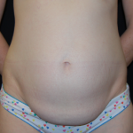 Tummy Tuck Before & After Patient #31063