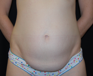 Tummy Tuck Before & After Patient #31063