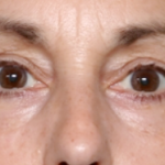 Blepharoplasty Before & After Patient #31075