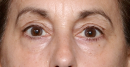 Blepharoplasty Before & After Patient #31075