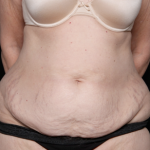 Tummy Tuck Before & After Patient #31118