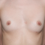 Breast Augmentation - Saline Implants Before & After Patient #31129