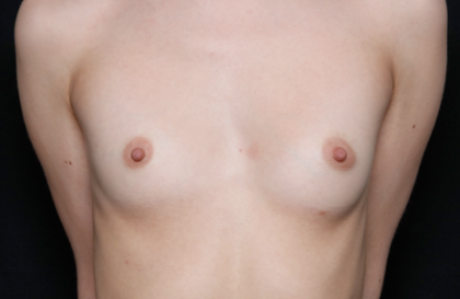 Breast Augmentation - Saline Implants Before & After Patient #31129