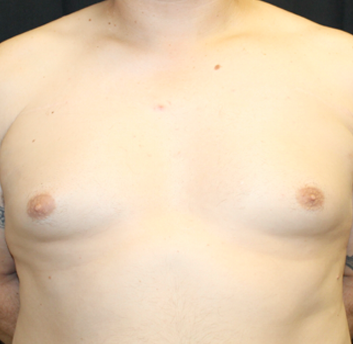 Gynecomastia Before & After Patient #31146