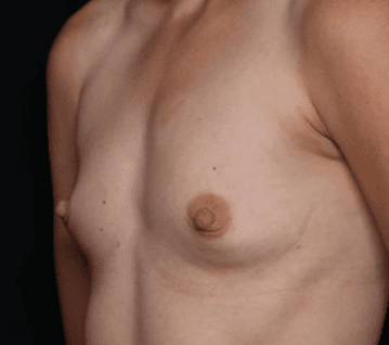 Breast Augmentation Before & After Patient #31038