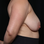 Breast Reduction Before & After Patient #31107