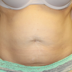 Tummy Tuck Before & After Patient #31180