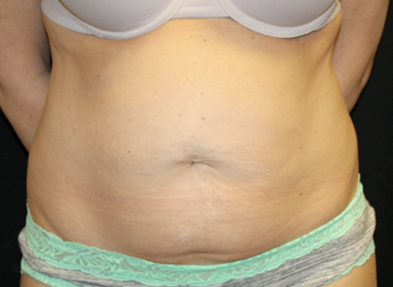 Tummy Tuck Before & After Patient #31180