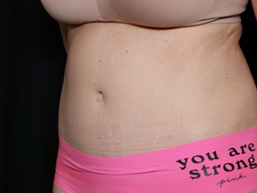 Tummy Tuck Before & After Patient #31180