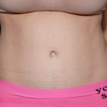 Tummy Tuck Before & After Patient #31180