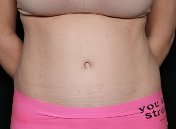 Tummy Tuck Before & After Patient #31180