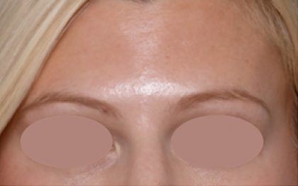 Botox and Dysport Before & After Patient #31198