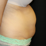 Tummy Tuck Before & After Patient #31180