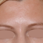 Botox and Dysport Before & After Patient #31198