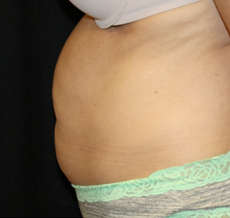 Tummy Tuck Before & After Patient #31180