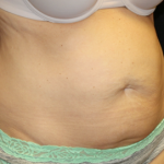 Tummy Tuck Before & After Patient #31180