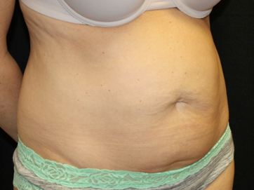 Tummy Tuck Before & After Patient #31180