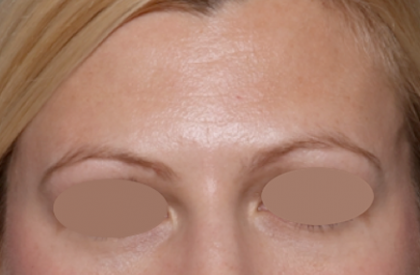 Botox and Dysport Before & After Patient #31198