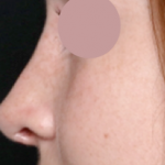 Rhinoplasty Before & After Patient #31157