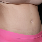 Tummy Tuck Before & After Patient #31180