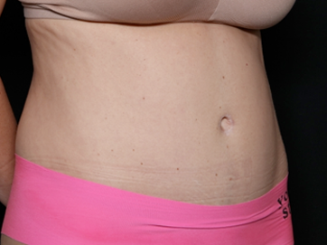 Tummy Tuck Before & After Patient #31180