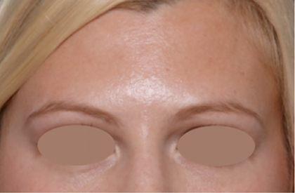 Botox and Dysport Before & After Patient #31198