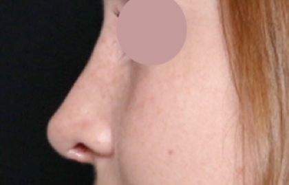 Rhinoplasty Before & After Patient #31157