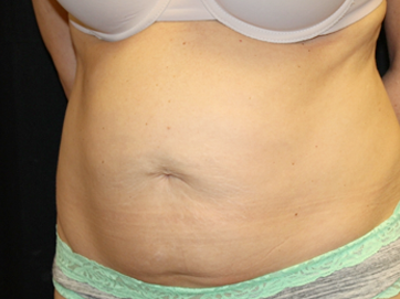 Tummy Tuck Before & After Patient #31180