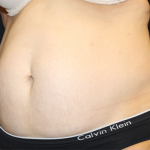 Tummy Tuck Before & After Patient #31207