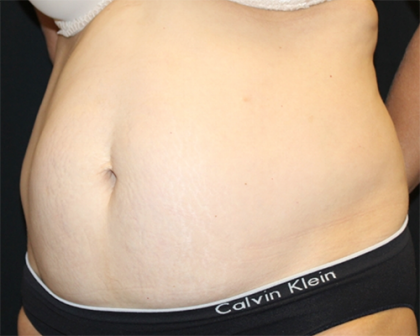 Tummy Tuck Before & After Patient #31207
