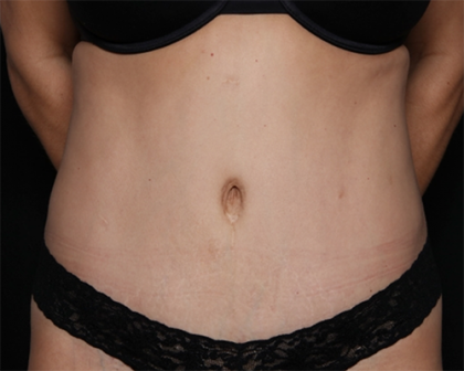 Tummy Tuck Before & After Patient #31207