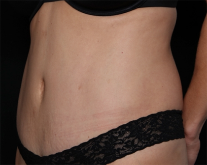 Tummy Tuck Before & After Patient #31207