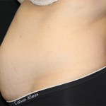 Tummy Tuck Before & After Patient #31207