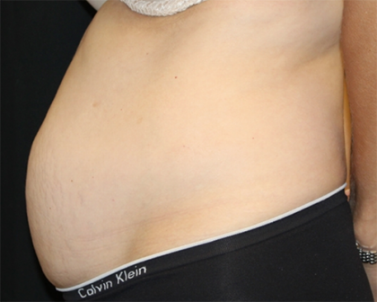 Tummy Tuck Before & After Patient #31207