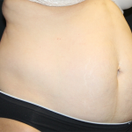 Tummy Tuck Before & After Patient #31207