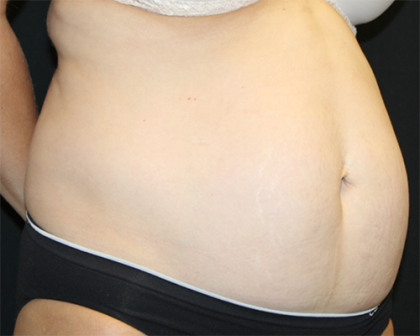 Tummy Tuck Before & After Patient #31207