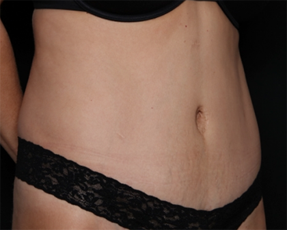 Tummy Tuck Before & After Patient #31207