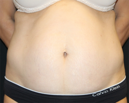 Tummy Tuck Before & After Patient #31207