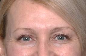 Botox and Dysport Before & After Patient #31227