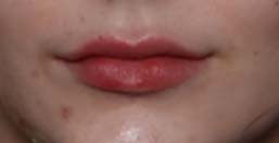 Lip Filler Before & After Patient #31224