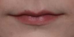 Lip Filler Before & After Patient #31224