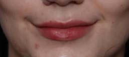 Lip Filler Before & After Patient #31224